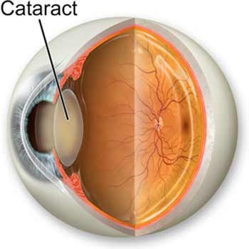 Cataract Services Image