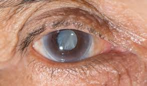 Glaucoma Services Image